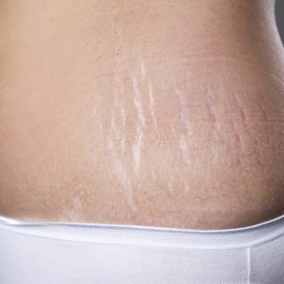 Top 3 Plastic Surgeries for Eliminating Stretch Marks